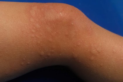 Light brown skin with small skin-coloured bumps from hives. A long description is available next.