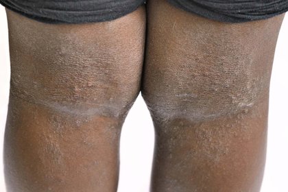 Atopic eczema on dark brown skin. There are dry patches on the back of some knees. A long description is available next.