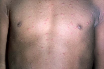 Stage 2 chickenpox on medium-brown skin with pink and white blisters. A long description is available next.