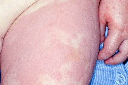 Hives rash on the thigh and hand of a child with white skin. A long description is available next.