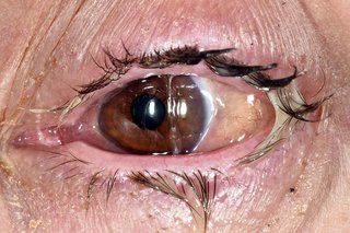 An eye with sticky yellow pus on the eyelashes.