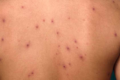 Stage 3 of chickenpox on light-brown skin with dark red scabs. A long description is available next.