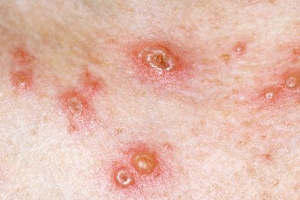 Stage 3 of chickenpox on white skin with blisters and scabs. A long description is available next.