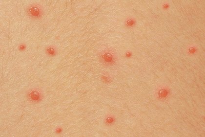 Stage 2 chickenpox on white skin with pink and shiny blisters. A long description is available next.
