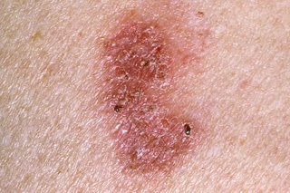 A small red patch on the skin. The patch is flat with an irregular outline and looks dry and scaly. Shown on white skin.