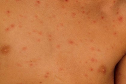 Stage 1 chickenpox on light-brown skin with red or pink spots. A long description is available next.