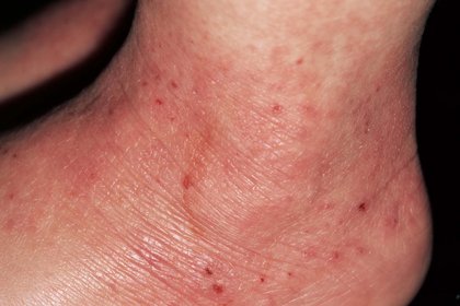 Atopic eczema on white skin. The skin on an ankle is pink and red with some scabs. A long description is available next.