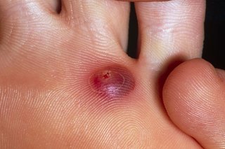 A small round bump on the sole of the foot, just below the toes, that's filled with dark red blood.
