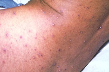 Stage 3 of chickenpox on medium-brown skin with pink, purple and grey scabs. A long description is available next.