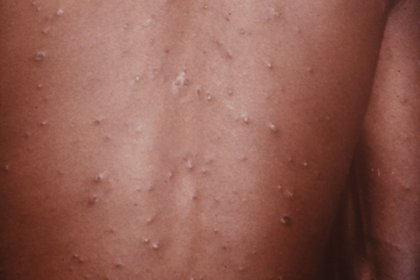 Stage 2 of chickenpox on dark-brown skin with raised blisters. A long description is available next.