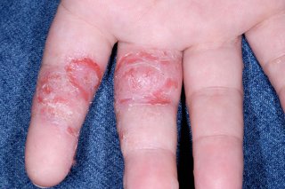 Pompholyx on the fingers of someone with white skin. Patches of skin are cracked, red and sore where the blisters have burst.