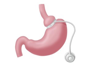 Diagram of a stomach with a tightened adjustable gastric band at the top of the stomach. At the end of the gastric band is the device to inflate it.