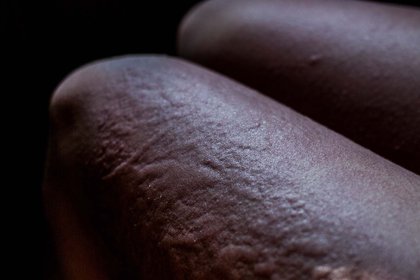 Dark brown skin with many raised patches on the thigh from hives. A long description is available next.