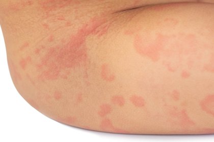 A child with light brown skin and the hives rash on their leg and hip. A long description is available next.