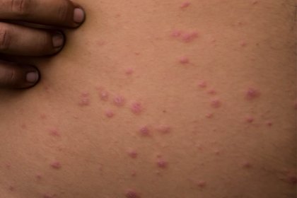 Stage 1 chickenpox on light-brown skin with pink and skin colour spots. A long description is available next.