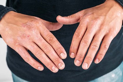 Atopic eczema on light brown skin. There are pink and white patches on the hands. A long description is available next.