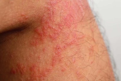 Atopic eczema on light brown skin. There are raised pink patches around a knee. A long description is available next.